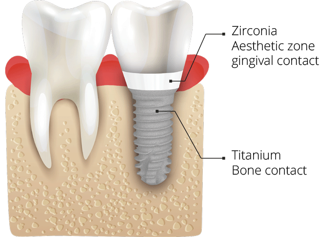 TBR Dental - Z1 Tissue Level Implants | Tbrdental